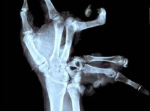 Xtreme X-rays - Broken Hand