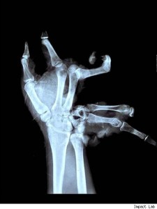 Xtreme X-rays - Broken  Hand