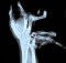 Xtreme X-rays - Broken Hand