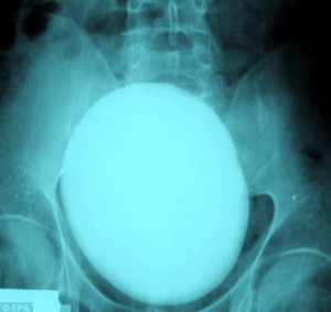 Xtreme X-rays - Kidney Stone